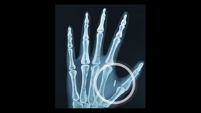 Sparda Bank Macht Werbung Fur Implantierten Rfid Chip Video